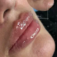 تخفیف فیلر فول فیس،انجام لیفت ابرو و جوانسازی بانخ