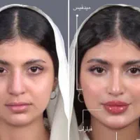 جشنواره ۵۰٪تخفیف بوتاکس،فیلر لب روسی،و زاویه‌سازی