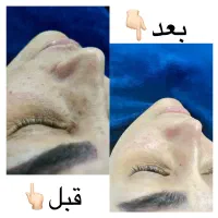 تخفیفات ما رواز دست ندیدن چند درجه پوست روشن تر کن