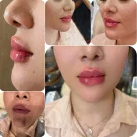 فیلر بوتاکس هایفو مزو خال برداری پی آر پی لیزر