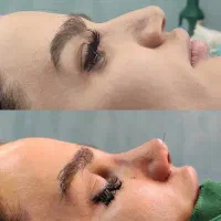 عمل بینی ۴۸۹۰۰تومن صفر تا صد
