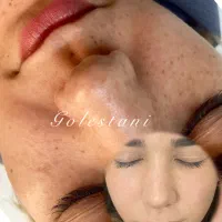 رفع کک مک پلک مزونیدلینگ تخفیف ویژه