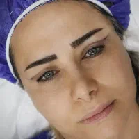 بلفاروپلاستی پلک بابخیه لیزری/سانترال لب/کاشت ابرو