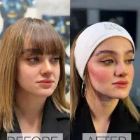 تخفیفات ویژه فیلر بوتاکس مزو