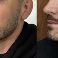 تخفیف ویژه ژل و بوتاکس و آنزیم