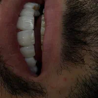 کامپوزیت به سبک لیرینگ با روز ترین متدد روز دنیا