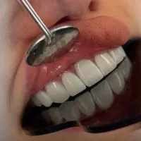 کامپوزیت دندان ( طراحی لبخند)