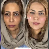 جشنواره فیلر فول فیس ژل بوتاکس نخ هایفو بلفارو