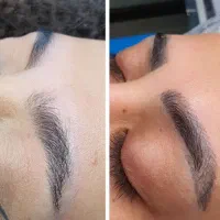 ریموو تتو صورت تضمینی «با تخفیفی باور نکردنی»