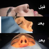 جراحی بینی ۳۵ میلیون تومان