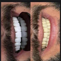 کامپوزیت دندان نقد فکی۱۴م تومانvipدرمحل زیباجو