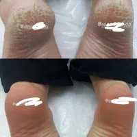 پدیکور تخصصی رفع ترک پا در ۱ جلسه