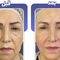 جشنواره هایفوتراپی جوانسازی و لیفت صورت و بدن