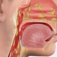 تشخیص و اصلاح مزاج بلغم و سودا ،خلط پشت حلق