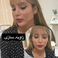 جشنواره ویژه یک هفته‌ای ژل و بوتاکس فیلر بادی
