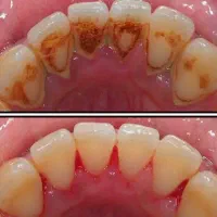 جرمگیری وبلیچینگ تخصصی دندان