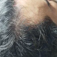 درمان ریزش مو