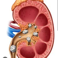 درمان سنگ کلیه