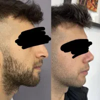پرپشتی قطعی ریش