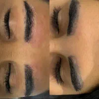 انجام ریموو تتو و روشن کنندگی نواحی تیره ی بدن