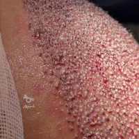 کاشت مو پرتراکم با تضمین کتبی نقد اقساط|خدمات آرایشگری و زیبایی|ساری, |دیوار