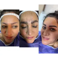 جشنواره کاشت ابرو و کاشت مو در کرج و حومه