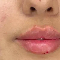 کلینیک زیبایی و لیزر و لاغری بوتاکس ژل لب