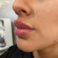 خدمات  ژل و بوتاکس ویژه تابستان