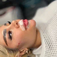 ژل بوتاکس