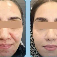 جوانساز، بیوممتیک، جایگزین بوتاکس و لیزر