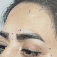 بوتاکس تخصصی