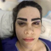 ساکشن غبغب بلفاروپلاستی،دایرکت ابرو، ساب برو لیفت