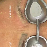 پاک کردن تتو و سفید کردن نواحی تیره  با لیزر