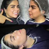 لیپو غبغب/ بوکال فت
