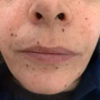 برداشتن خال و زگیل