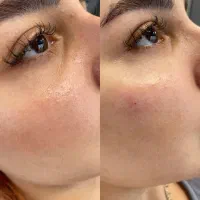 فشیال و کربوکسی تراپی