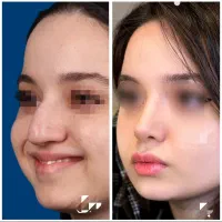 کانال روبیکا و بله/نمونه عمل دکتر غنی‌زاده/ارومیه