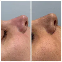 اگه فیشیال نتیجه نده هزینه نده(مخصوص عید)