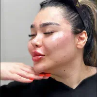 ژل صورت و بوتاکس و مزو جوان ساز
