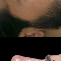 فیلر و بوتاکس .ساعت تماس ۱۶ الی ۲۰
