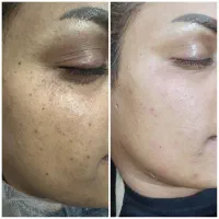 برداشتن خال و کک و مک کاملا تضمینی