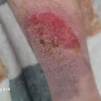 پودرمعجزه درمانی آتش سوزی