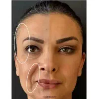 فیلربادی مزوژل فیلر صورت لیفت شقیقه بوتاکس لاغری