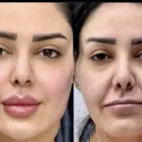 تخفیف ۹۵درصدی فیلر مزوبامتدعربی بوتاکس prp