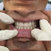 ساخت دندان مصنوعی با قیمت مناسب