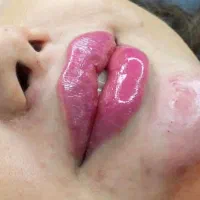 تخفیفات ژل و بوتاکس