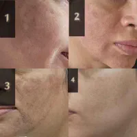تخفیف پاکسازی صورت