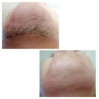 الکترولیز بانوان (رفع دائمی موهای زائد صورت و بدن)|خدمات آرایشگری و زیبایی|شیراز, گویم|دیوار