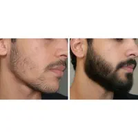 رویش ریش با محصولات ما فقط در ۳۵ روز
