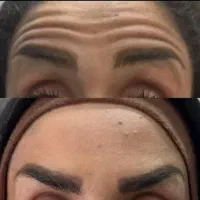 جشنواره بوتاکس کامل صورت